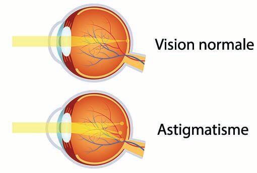 astigmatisme