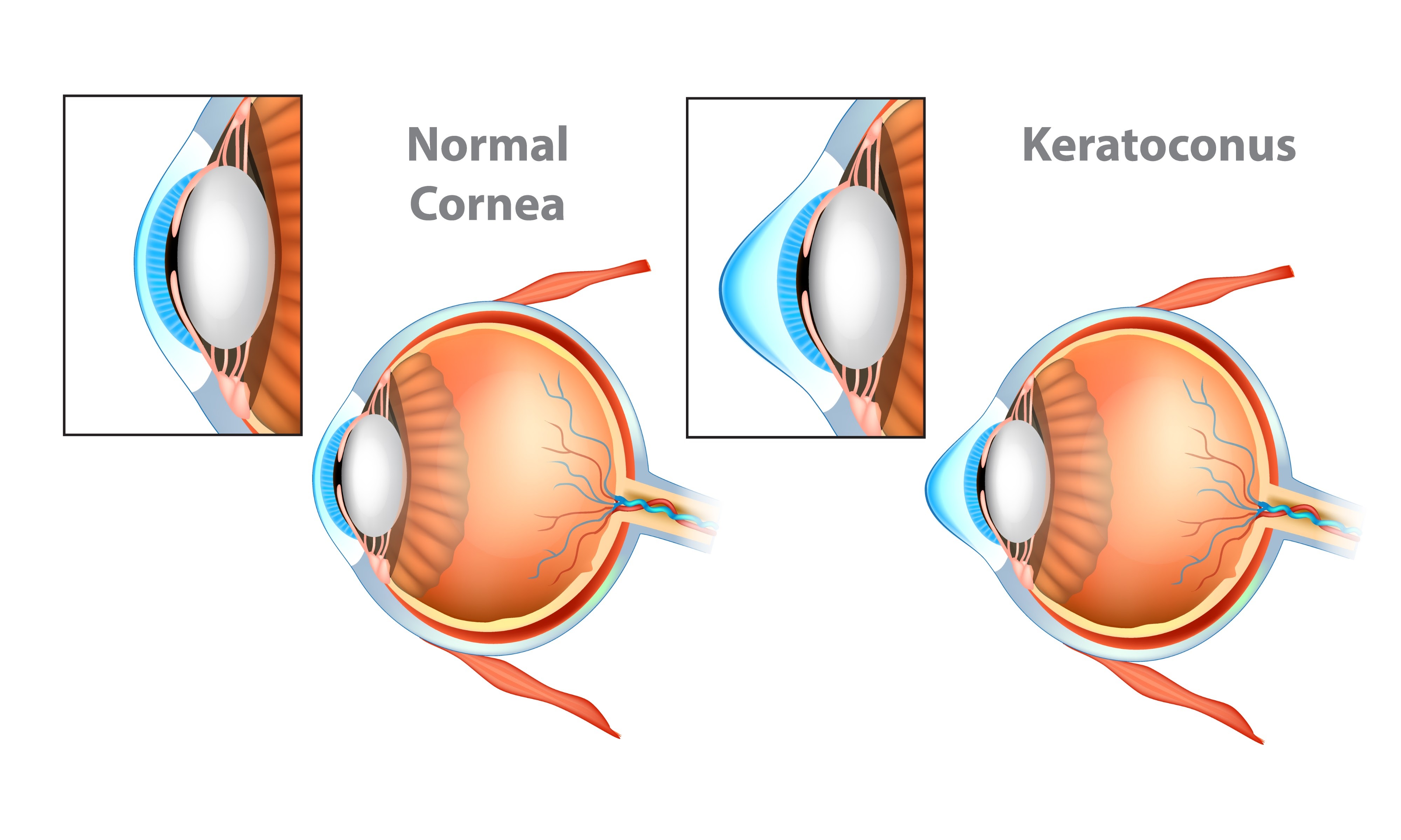 Image de keratoconus cornea shape vs normal cornea